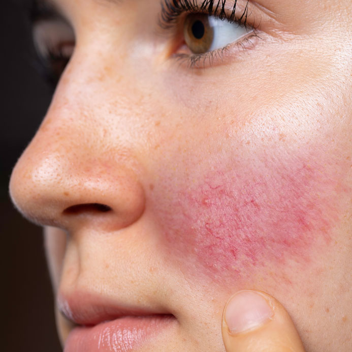 rosacea